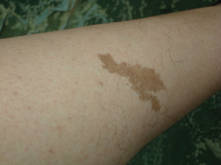 简析咖啡斑的症状有哪些