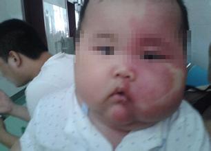 怎样区别鲜红斑痣与新生儿斑痣