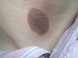 上海的治疗咖啡斑医院哪个较好