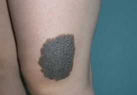 黑色素痣什么疗法好治疗