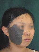 兽皮痣的治疗费用