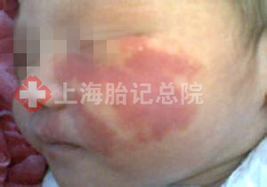 上海哪里有去除鲜红斑痣的医院